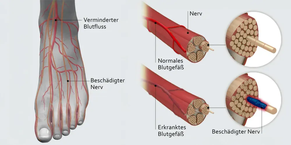 Akusoli Nerves split graph C SM DE